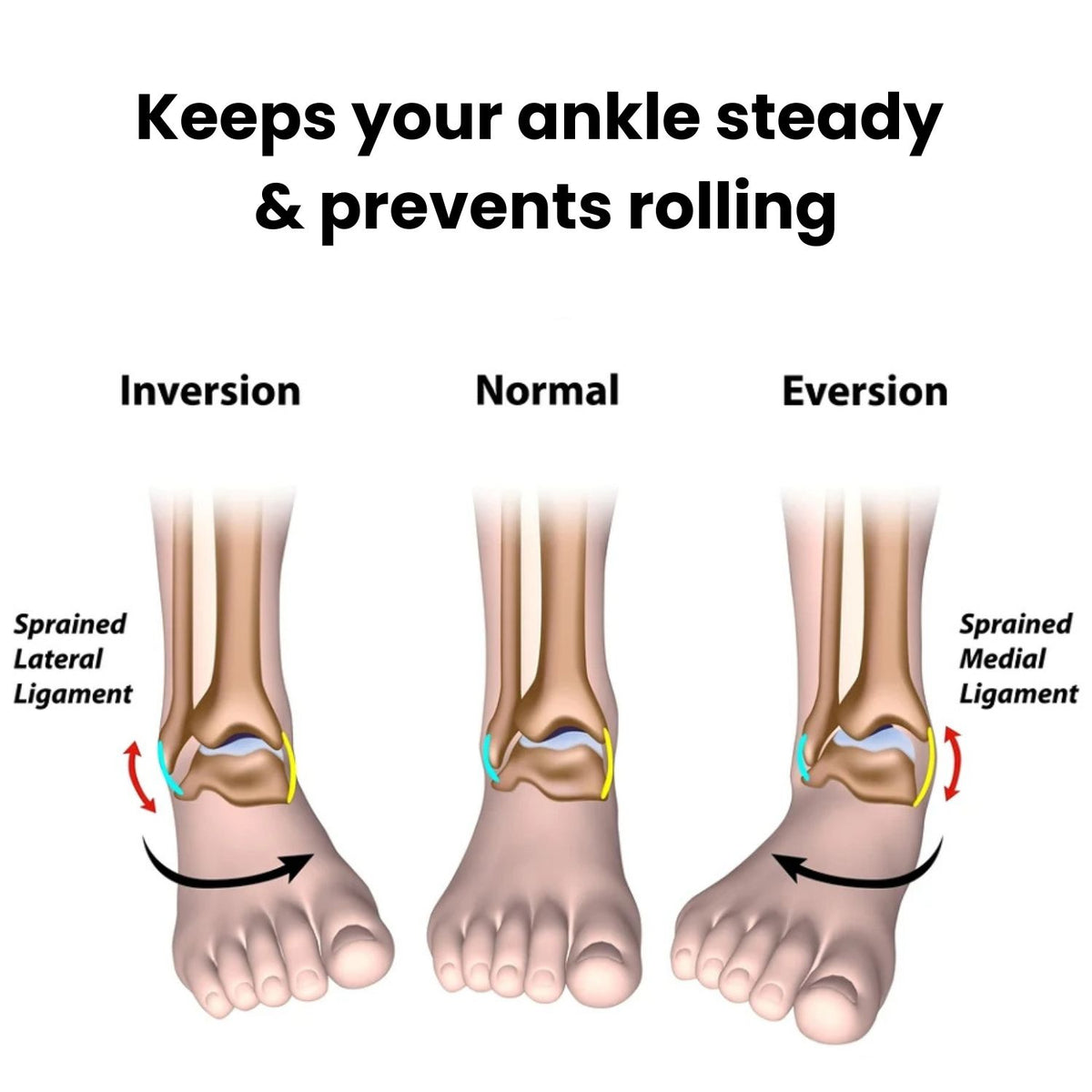 StepLift 2.0 - Instantly stops drop foot (Adjustable)